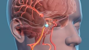 VI nerve Palsy - clinical image 6 of 6