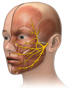 Old Facial Palsy - clinical image