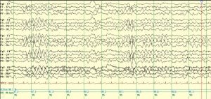 Ictal Vomiting - clinical image 1 of 5