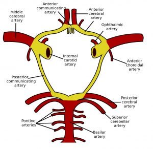 CNS Vasculitis - clinical image 4 of 5