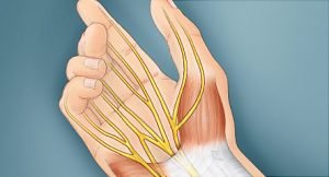 Carpal Tunnel Syndrome - clinical image